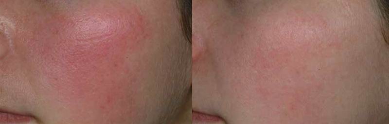 fotofacial_ipl_10.jpg