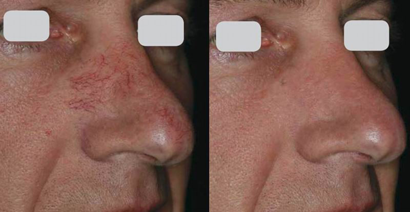 fotofacial_ipl_18.jpg