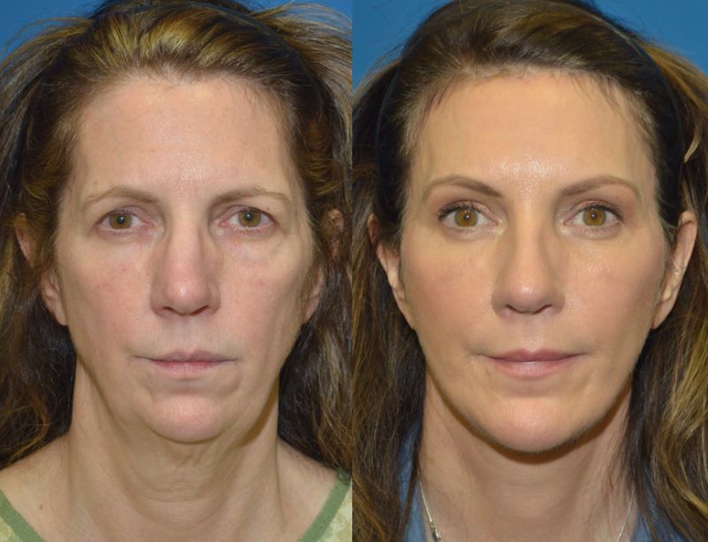 full_face_lift-01.jpg