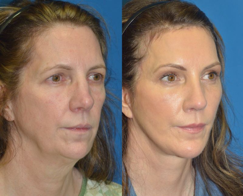 full_face_lift-02.jpg