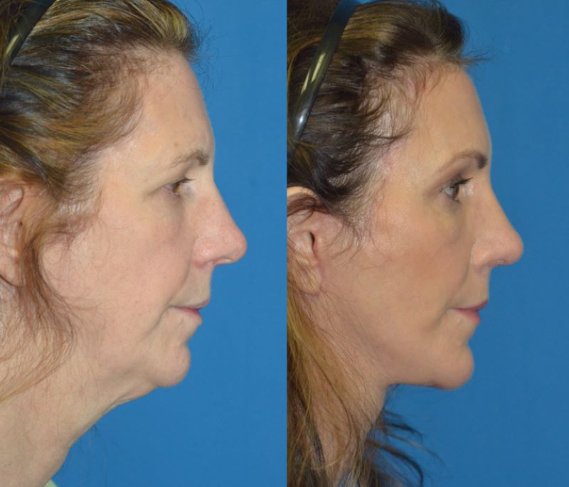 full_face_lift-03.jpg