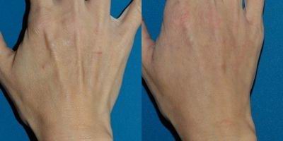 before and after fat grafting to hand