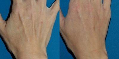 before and after fat grafting to hand before and after fat grafting to hand