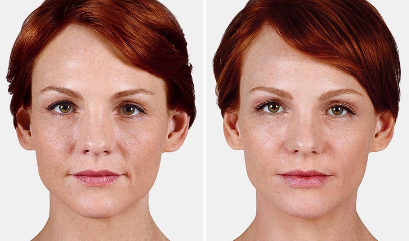 juvederm04.jpg