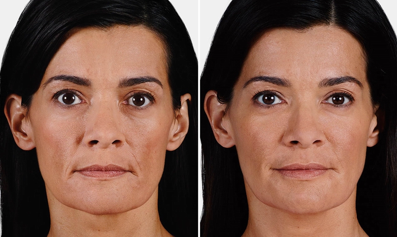 juvederm05.jpg