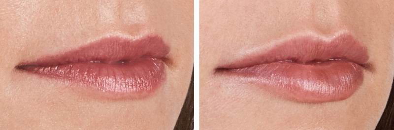 juvederm_volbella_01.jpg