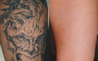 Laser Tattoo Removal Seattle  Seattles Premier Tattoo Removal