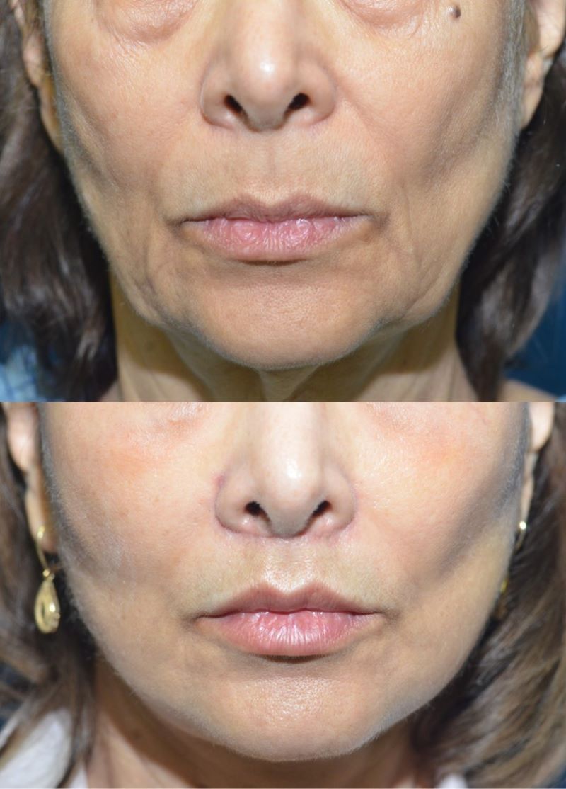 Before and after lip lift, deep plane facelift and fat grafting by Sam Naficy, MD, FACS, Bellevue WA