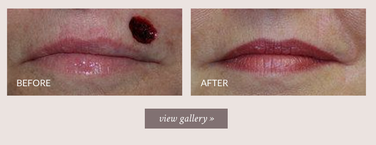 lip-reconstruction-gallery.jpg