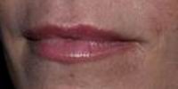 After restylane lip augmentation