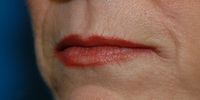 Before lip augmentation using Gore-Tex
