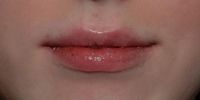 After lip augmentation using Restylane