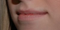 Before lip augmentation using Restylane