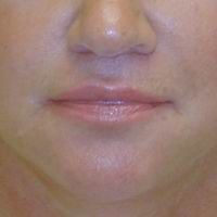 After lip lift, corner of the mouth lift, and lip augmentation with fat