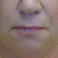 Before lip lift, corner of the mouth lift, and lip augmentation with fat