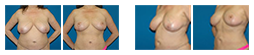 liposuction.png