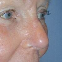 After nasal reconstruction using a regional flap