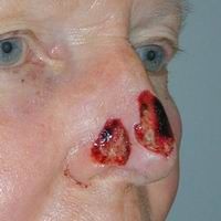 Before nasal reconstruction using a regional flap