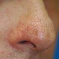 After nasal reconstruction using a skin and cartilage graft 