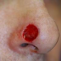 Before nasal reconstruction using a skin and cartilage graft 