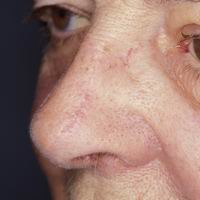 After nasal reconstruction using primary closure