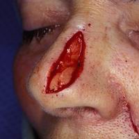 Before nasal reconstruction using primary closure