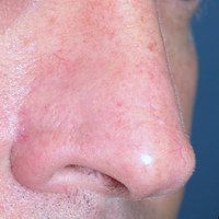 After nasal reconstruction using a local flap