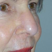 After nasal reconstruction by Sam Naficy, MD following removal of a basal cell carcinoma