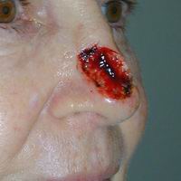 Before nasal reconstruction by Sam Naficy, MD following removal of a basal cell carcinoma