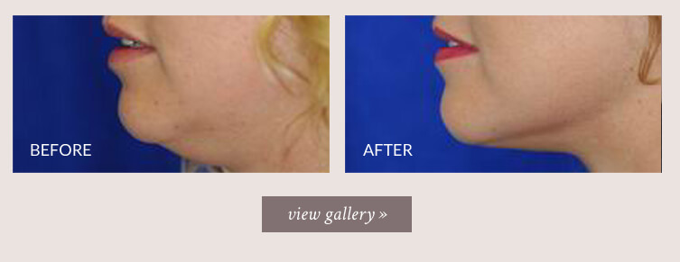 neck-lipo-gallery.jpg