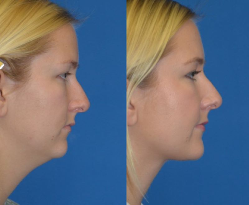 neck_lipo02_800.jpg