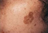 Before treatment of brown spots on face
