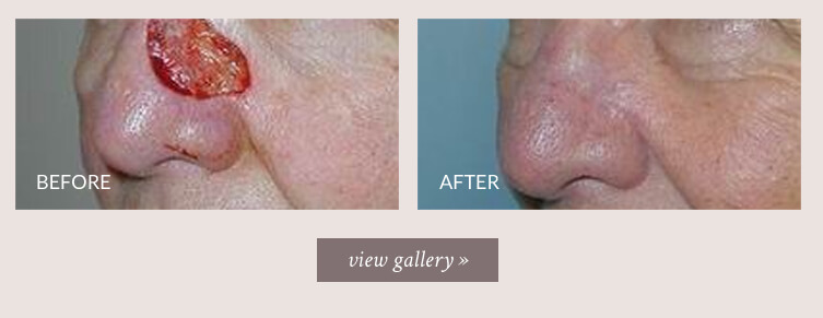 nose-reconstruction-gallery.jpg