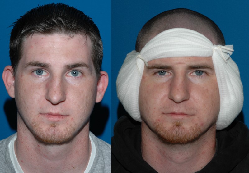 Patient before otoplasty, and wearing the bulky compression head dressing that is worn overnight after surgery