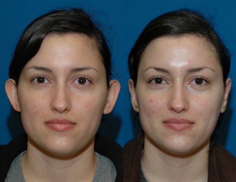 Before and after otoplasty in an adult woman, front view