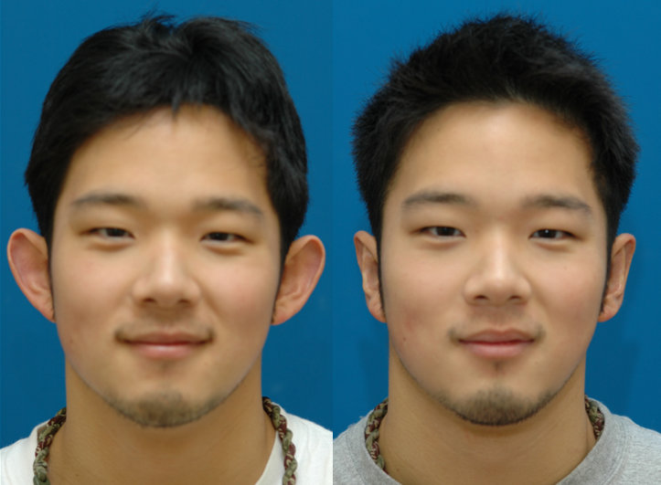 Before and after otoplasty in an adult patient, front view
