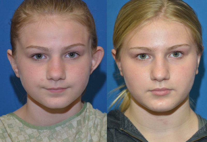 Before and after otoplasty in a young patient, front view