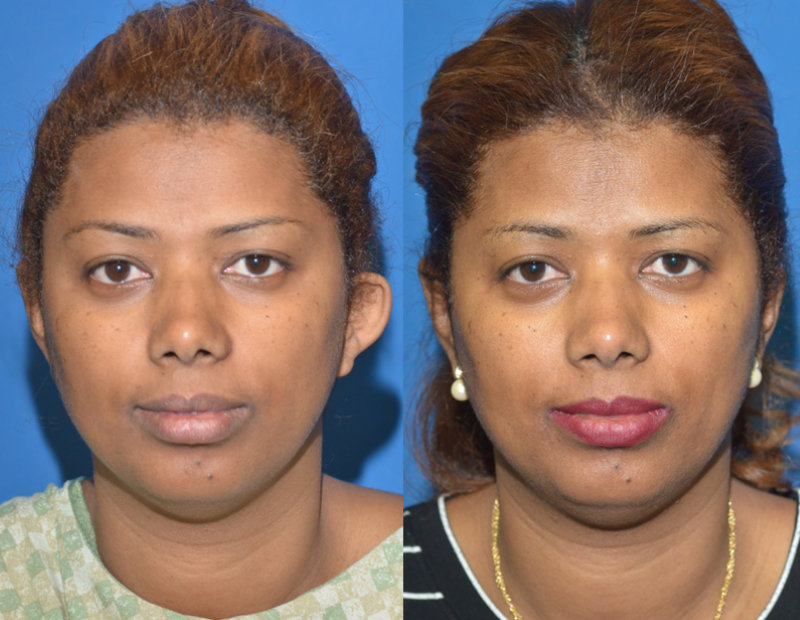 Before and after one-sided otoplasty correcting a single prominent ear