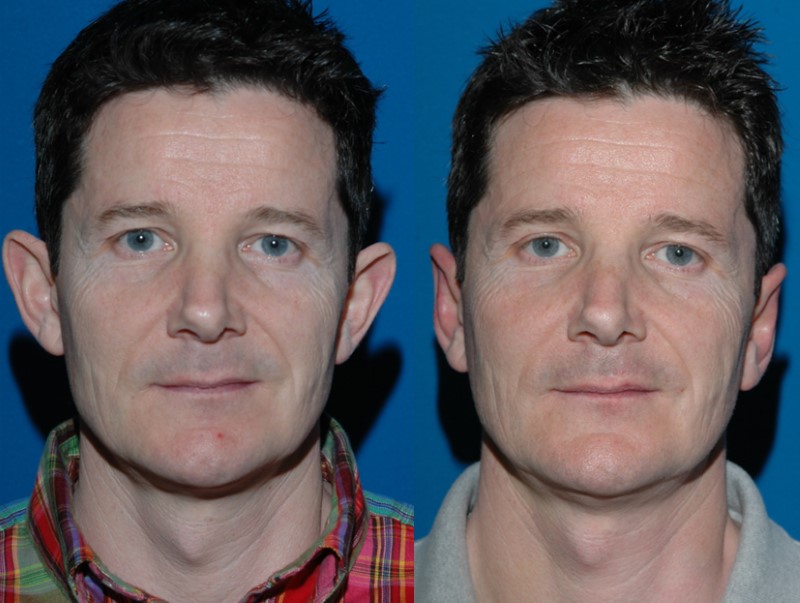 Before otoplasty and seven days after surgery, with the ears already close to their new position