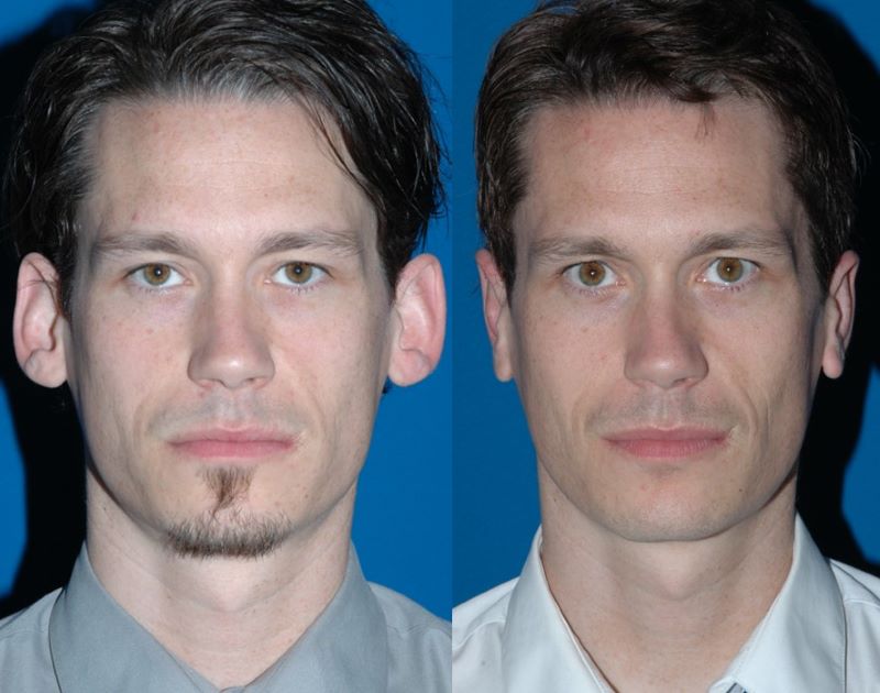 Before and after otoplasty in an adult man, front view, with prominent ears repositioned closer to the head
