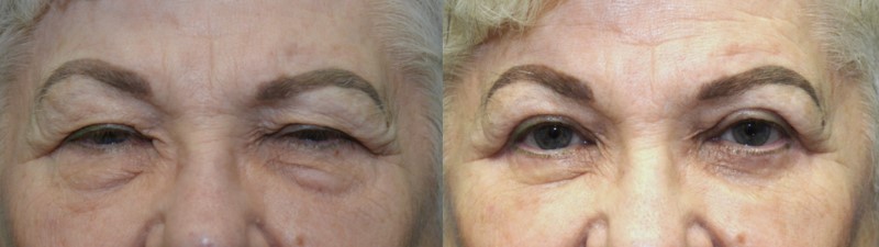 Before and after ptosis repair with upper and lower blepharoplasty and SOOF lift by Bryan Sires, MD, with both drooping upper eyelids elevated to expose the pupils