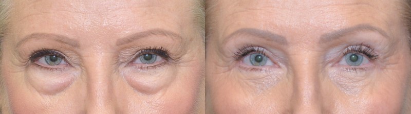 Before and after ptosis repair with upper and lower blepharoplasty and SOOF lift by Bryan Sires, MD, showing the upper eyelid margins raised and the lower lids smoothed