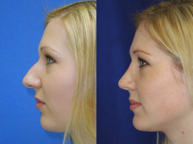 primary_rhinoplasty_0001.jpg