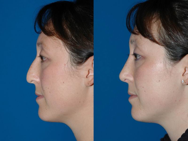 primary_rhinoplasty_0014.jpg