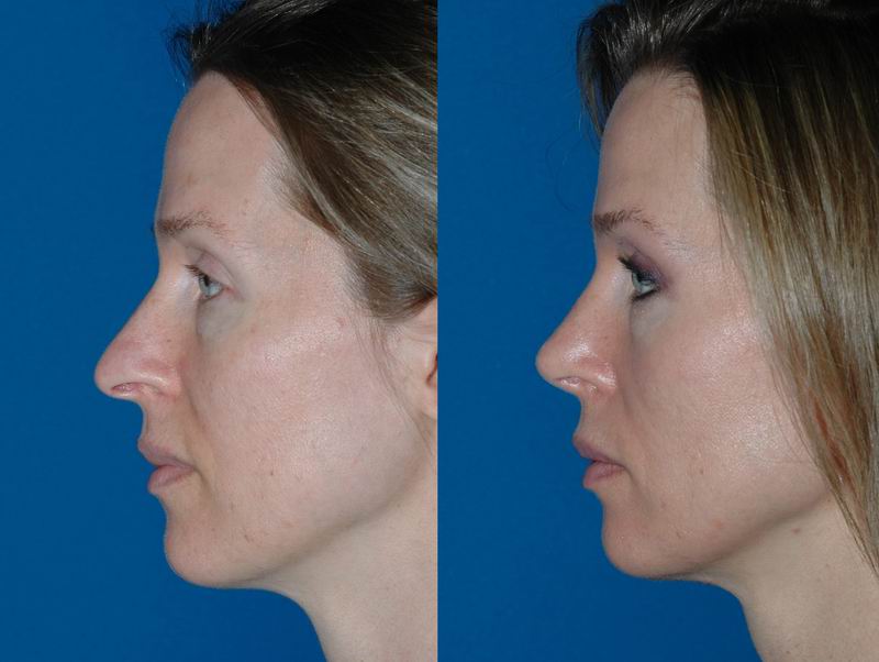 primary_rhinoplasty_0019.jpg