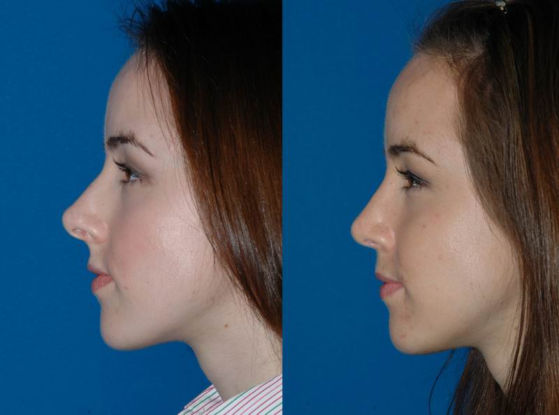 primary_rhinoplasty_0044.jpg