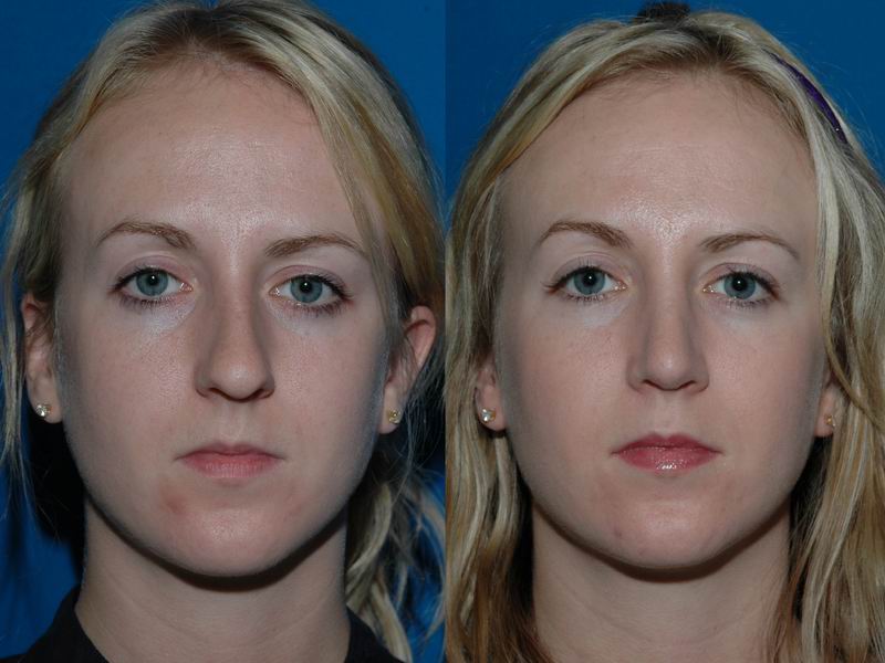 primary_rhinoplasty_0079.jpg