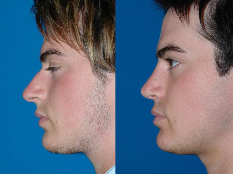 primary_rhinoplasty_0093.jpg