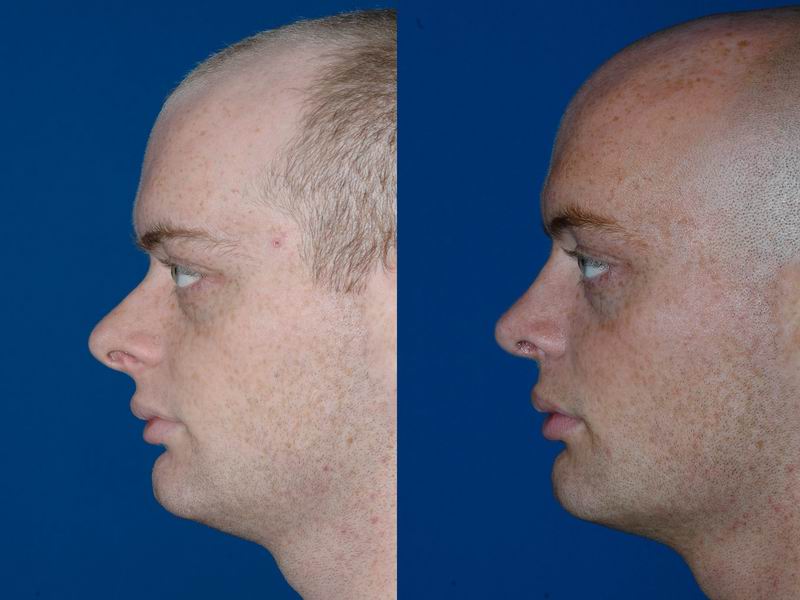 Rhinoplasty Seattle Bellevue- Award Winning Surgeon DrPhilip Young