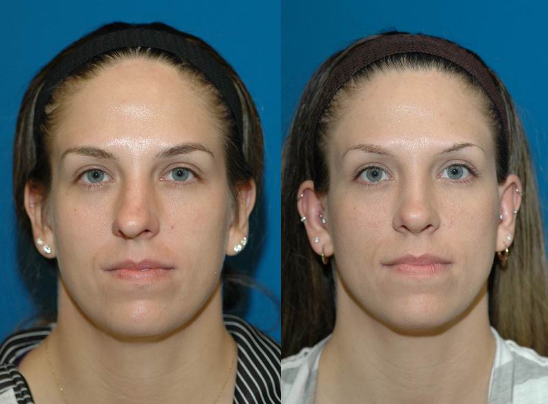 Rhinoplasty Seattle - Rhinoplasty Specialist - Bellevue Rhinoplasty